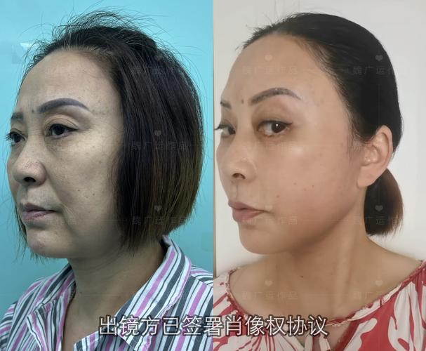 新疆玉雪尔祛斑过程效果如何？-第2张图片-花冠旅游服务