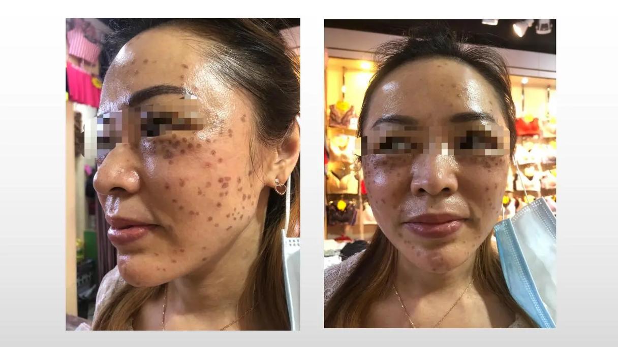 新疆玉雪尔祛斑过程效果如何？-第1张图片-花冠旅游服务